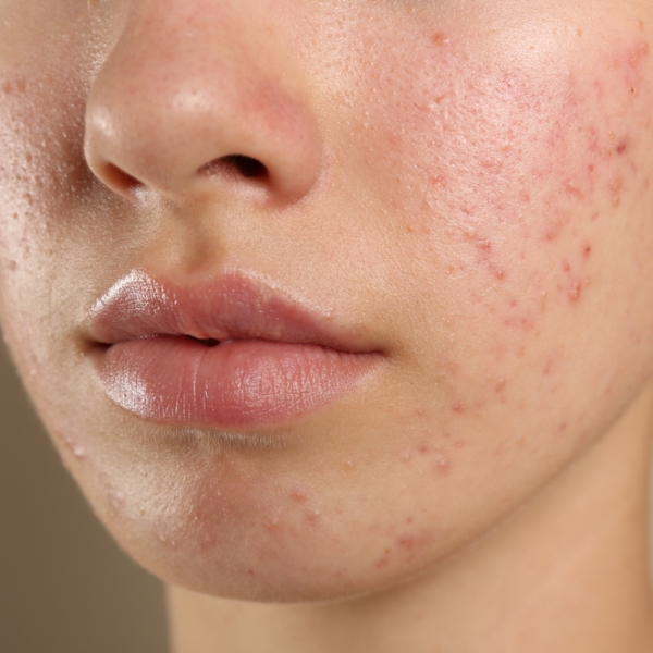 acne vulgaris